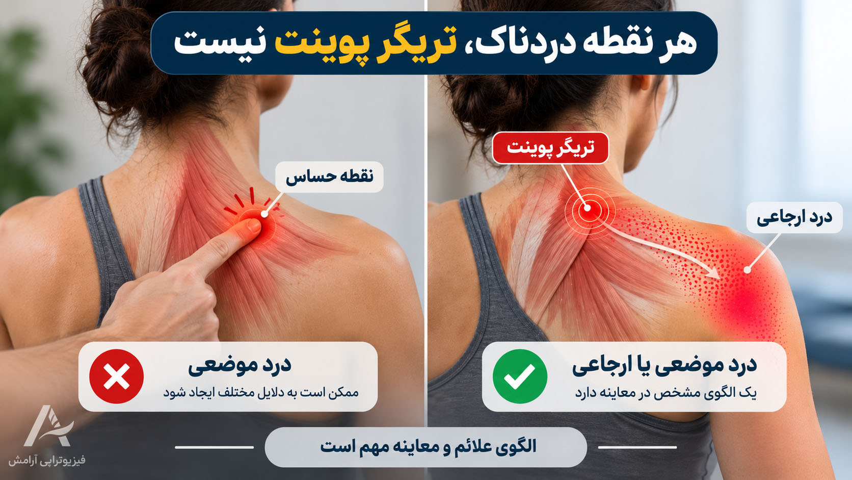 تفاوت نقطه حساس عضلانی با تریگر پوینت و الگوی درد ارجاعی